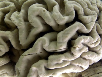 Silent brain changes precede Alzheimer’s. Researchers have new clues about which come first